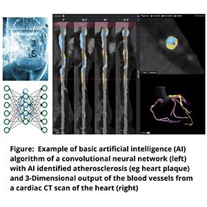 Figure: Example of basic artificial intelligence (AI) algorithm of a convolutional neural network (left) with AI identified atherosclerosis (eg heart plaque) and 3-dimensional output of the blood vessels from a cardiac CT scan of the heart (right)