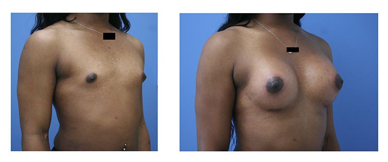 before and after of breast augmentation