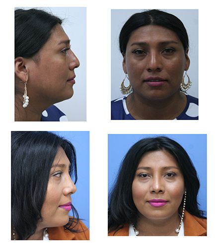 before & after of facial feminization surgery