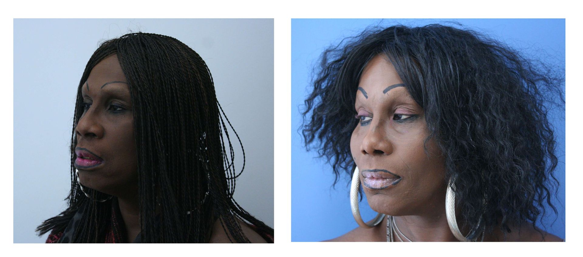 before & after of facial feminization surgery