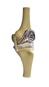 An image of the knee joint with a metal implant