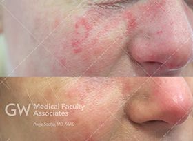 Two images, one before and one after, three weeks of treatment for a port wine birthmark. 