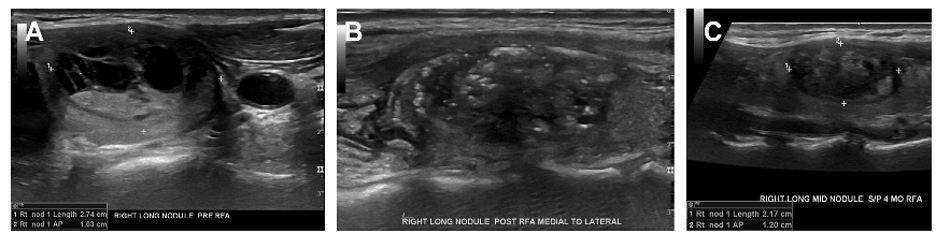Radiofrequency Ablation