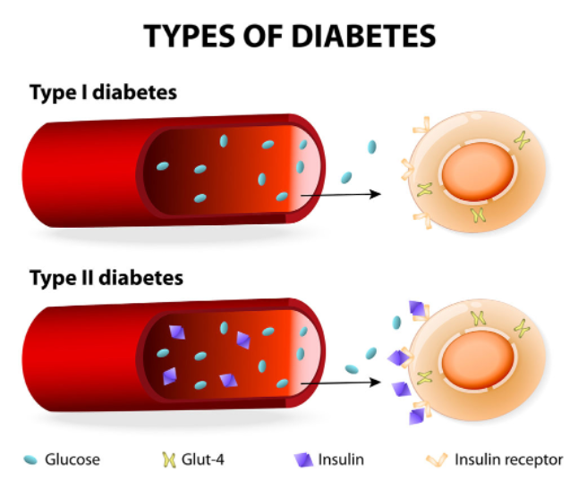 Types of diabetes diagram