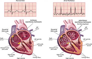 Norma EKG vs Atrial Fibrillation comparison diagram